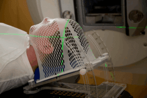 Radiation Therapy Long-Term Effects to Know