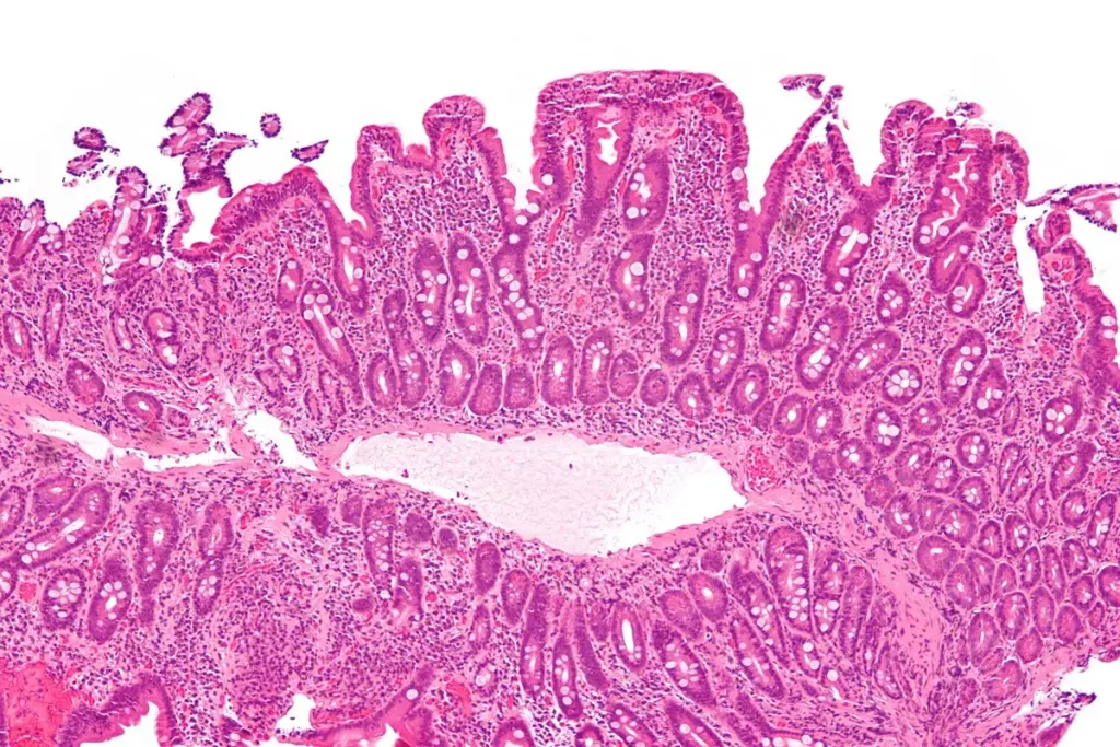 Can Celiac Disease Lead to Cancer? Understanding the Link