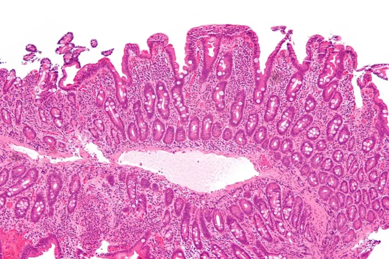 Can Celiac Disease Lead to Cancer? Understanding the Link