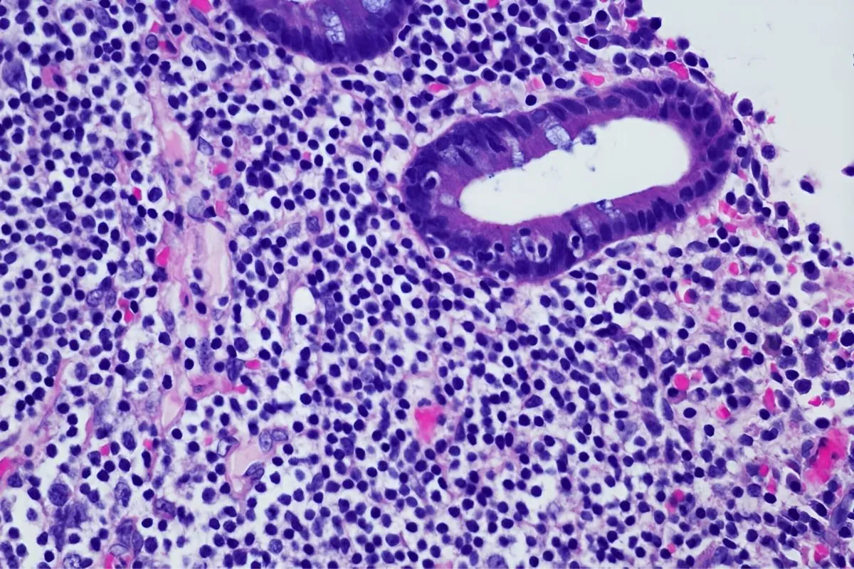 Therapy-Related MDS (t-MDS)