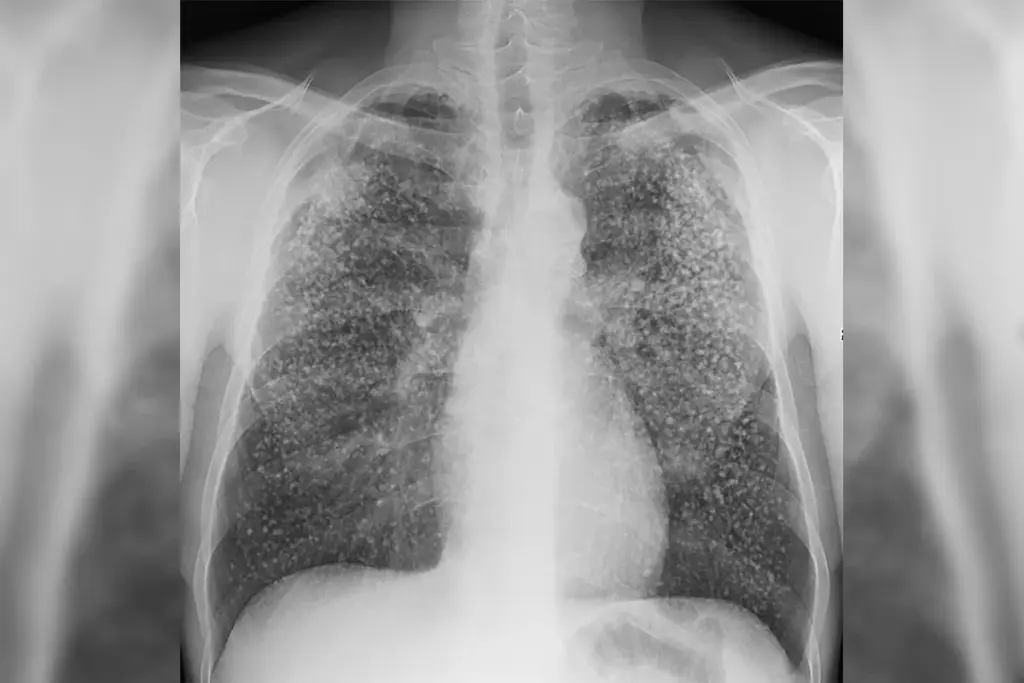 Classification: Pulmonary and Extrapulmonary Disease