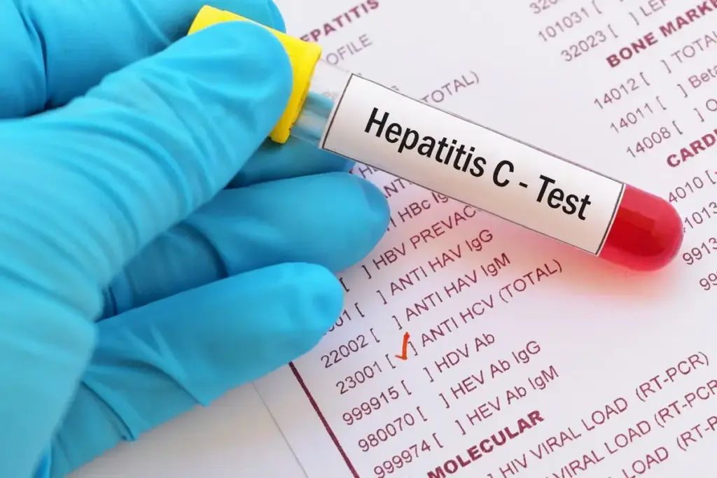 Hepatitis C