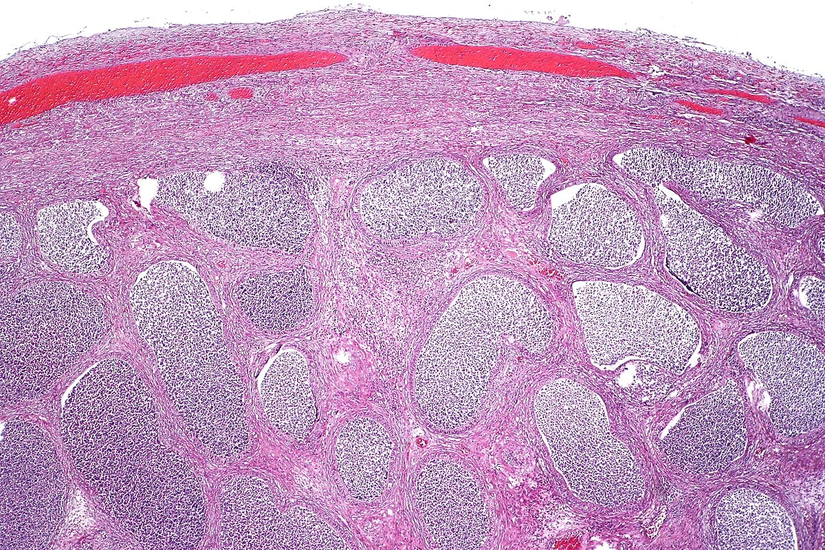 Epididymitis