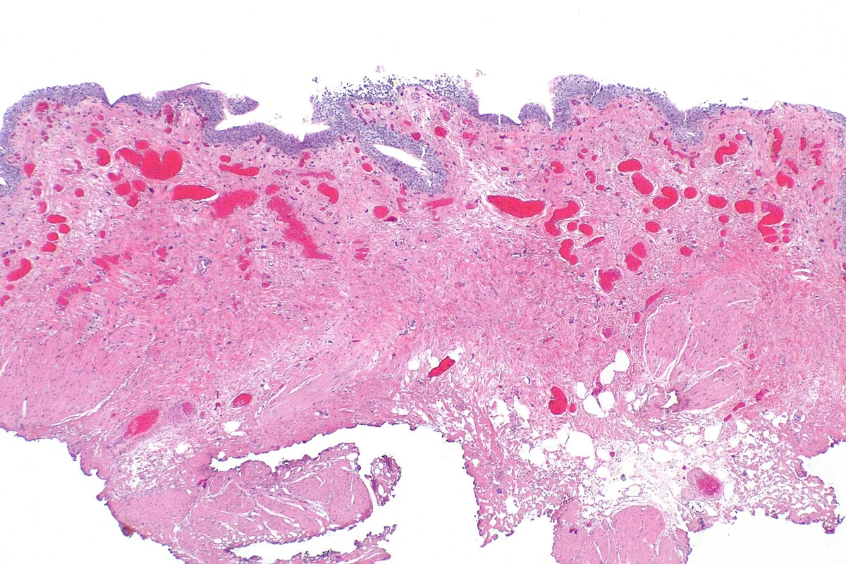 The Spectrum of Bladder Pathologies