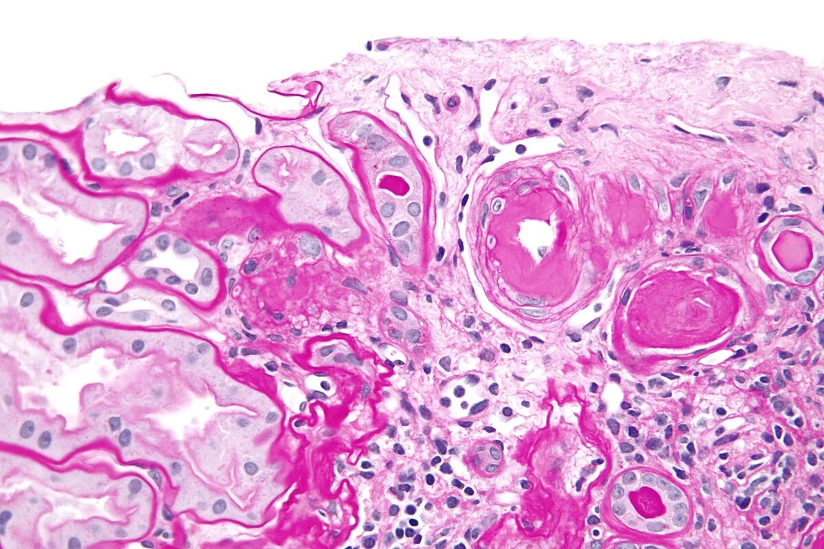 Systemic risk factors and metabolic comorbidities