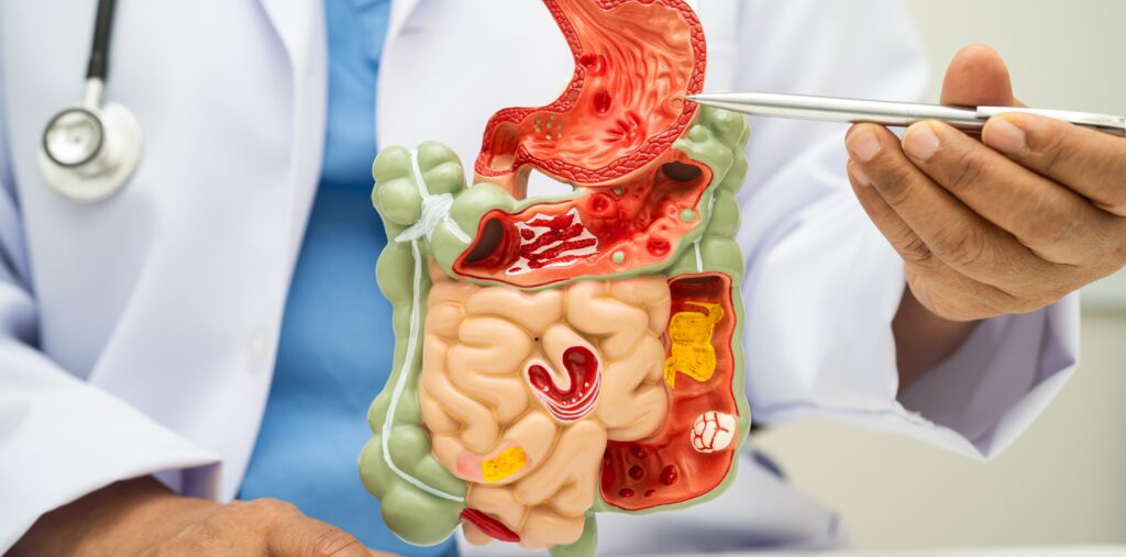 Gastrointestinal Bleeding