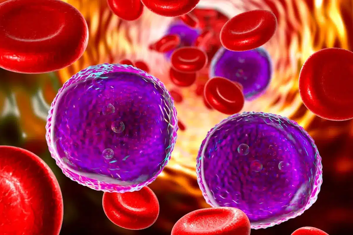 Major Types of Lymphocytic Leukemia