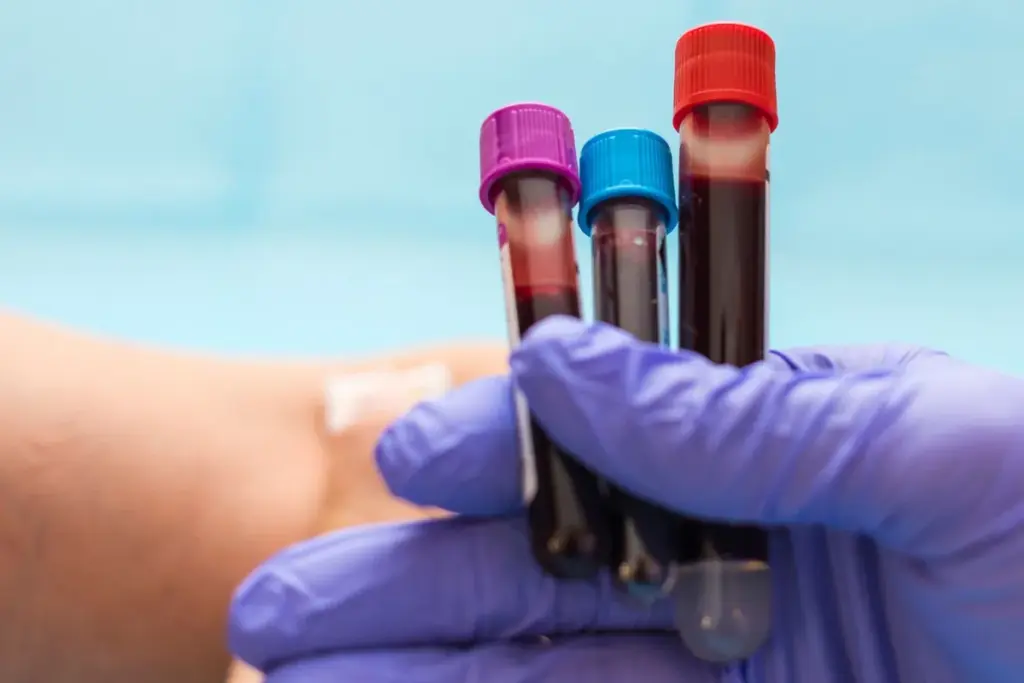 Lymphocytic Leukemia: Diagnosis and Tests