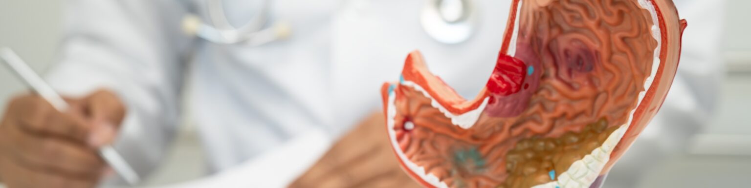 Irritable Bowel Syndrome