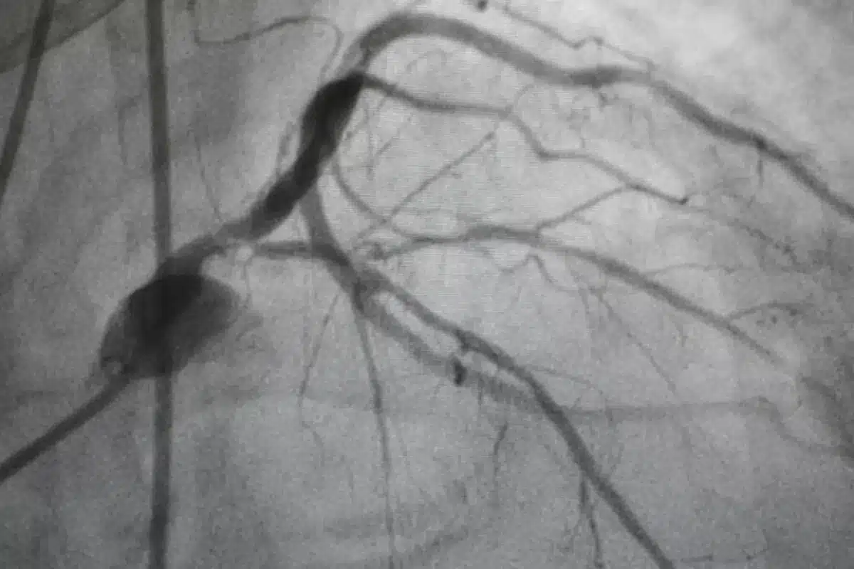 Coronary Angiography