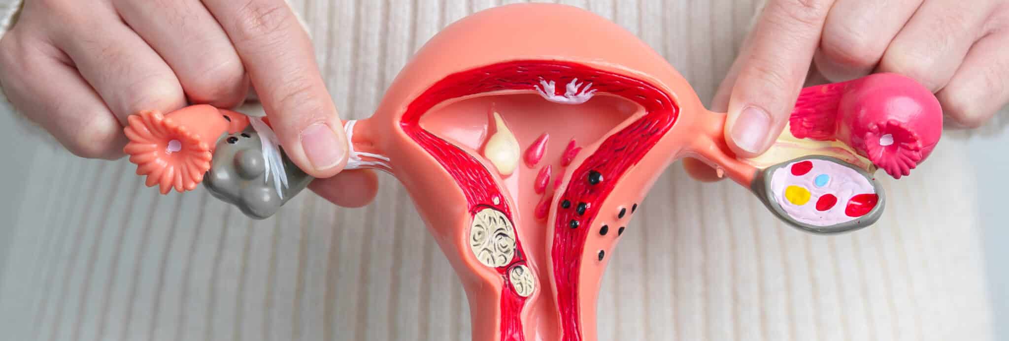 Woman holding Uterus and Ovaries model. Ovarian and Cervical cancer, Cervix disorder, Endometriosis, Hysterectomy, Uterine fibroids, Reproductive system and Pregnancy concept