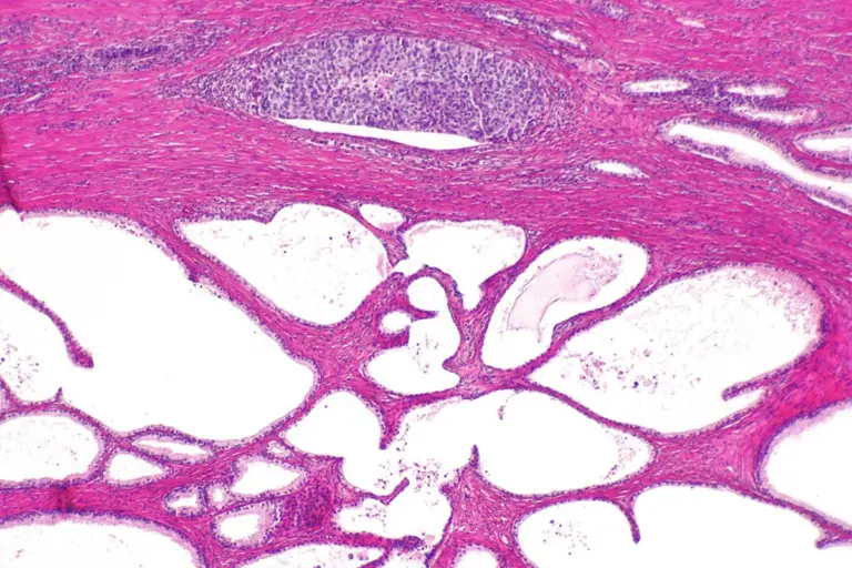 Urethra Diseases Symptoms and Risk Factors