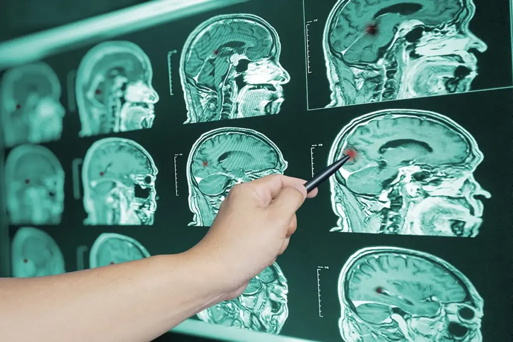 Traumatic Brain Injury: Symptoms and Risk Factors