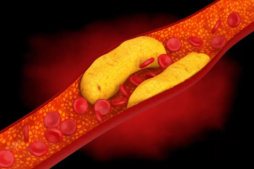 Coronary Stent Applications