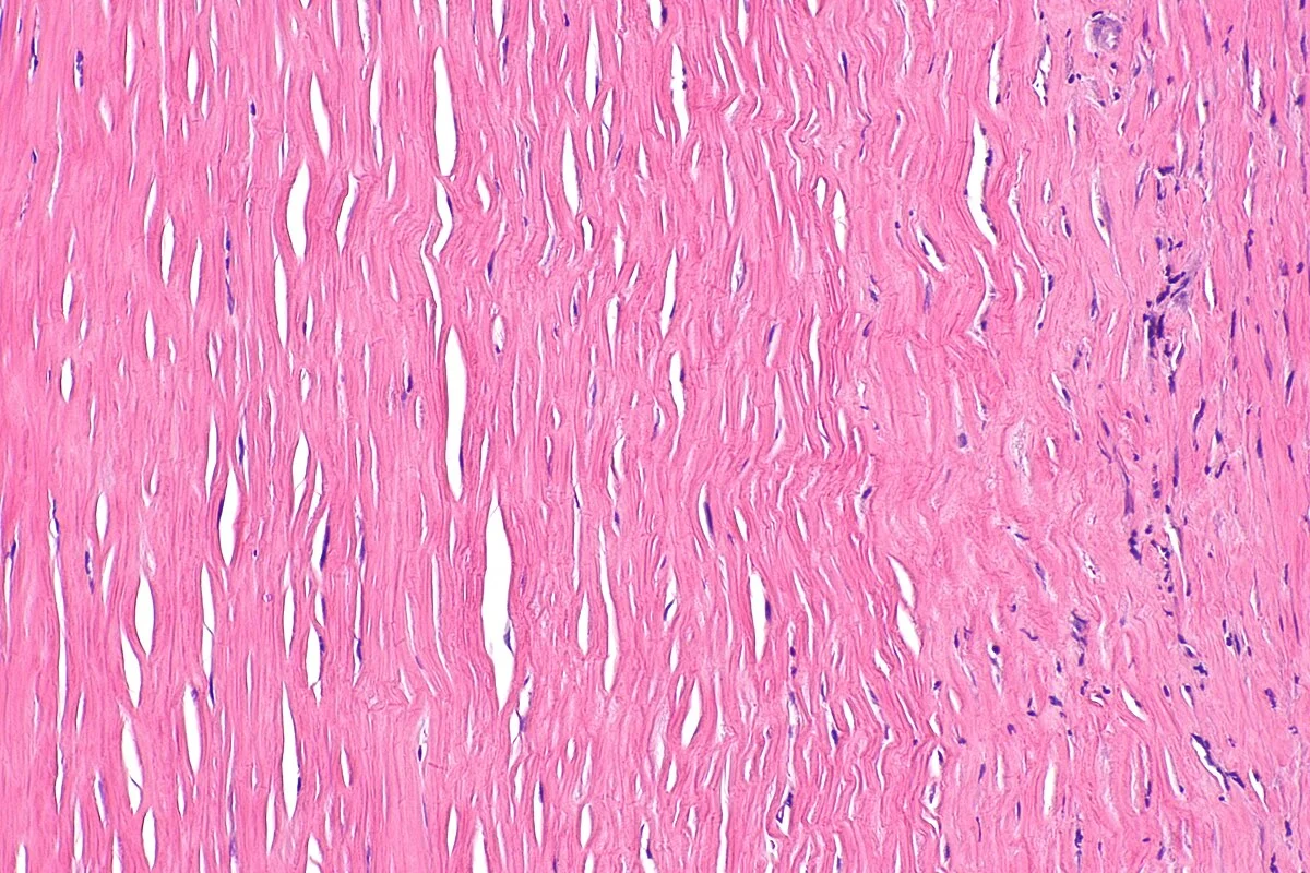 The Origin of Fibroids