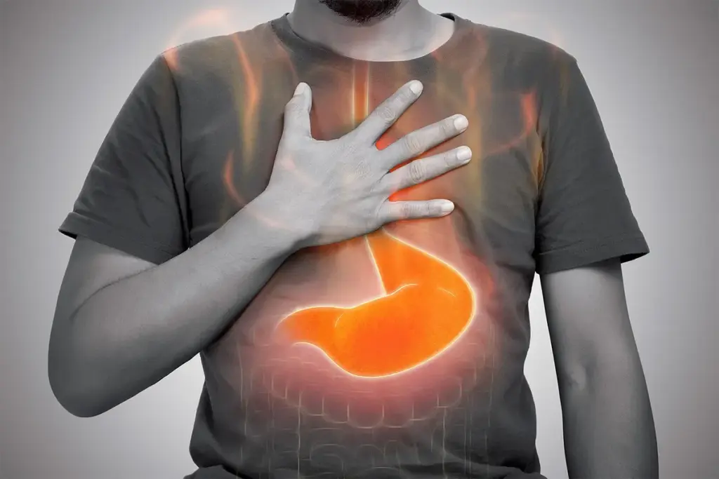 Reflux Disease: Overview And Definition