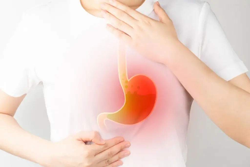 Functional Assessment Of Reflux Episodes