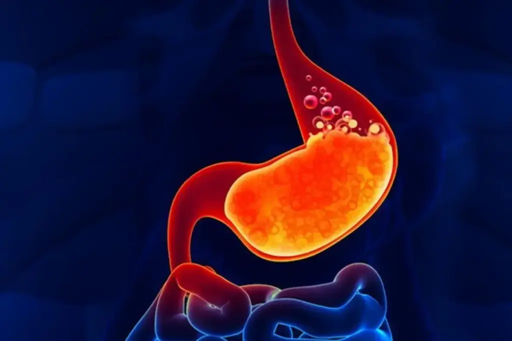 Understanding Recovery In Reflux Disease