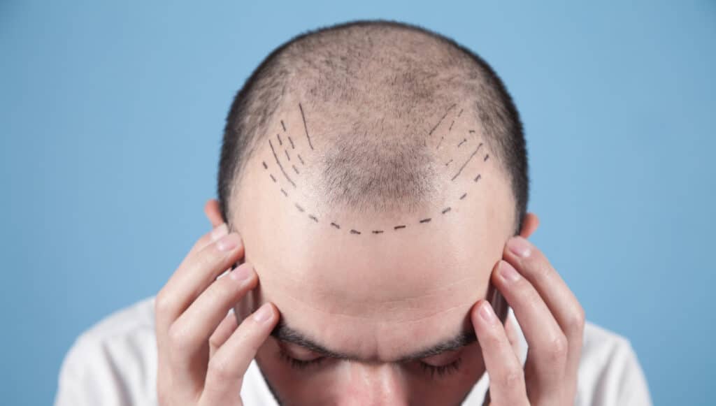 fue-hair-transplant