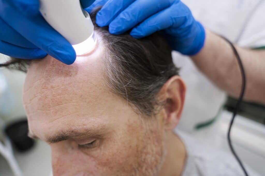 fue-hair-transplant