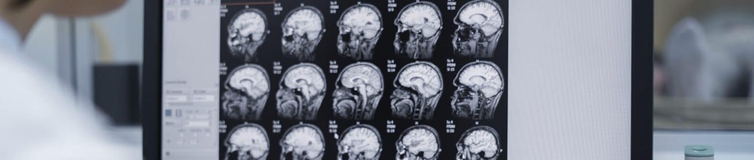 Autonomic Neuropathy