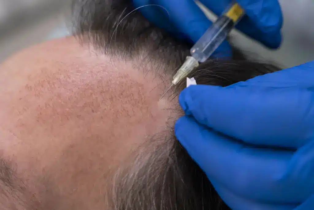 fue-hair-transplant