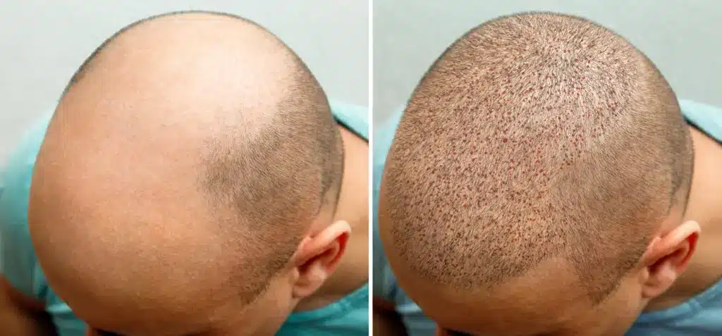 fue-hair-transplant