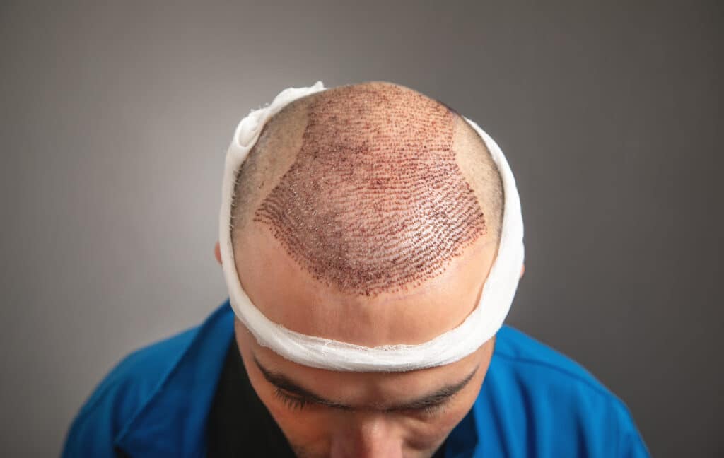 fue-hair-transplant