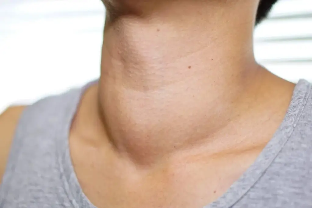 The Neck Mass: A Sentinel Sign