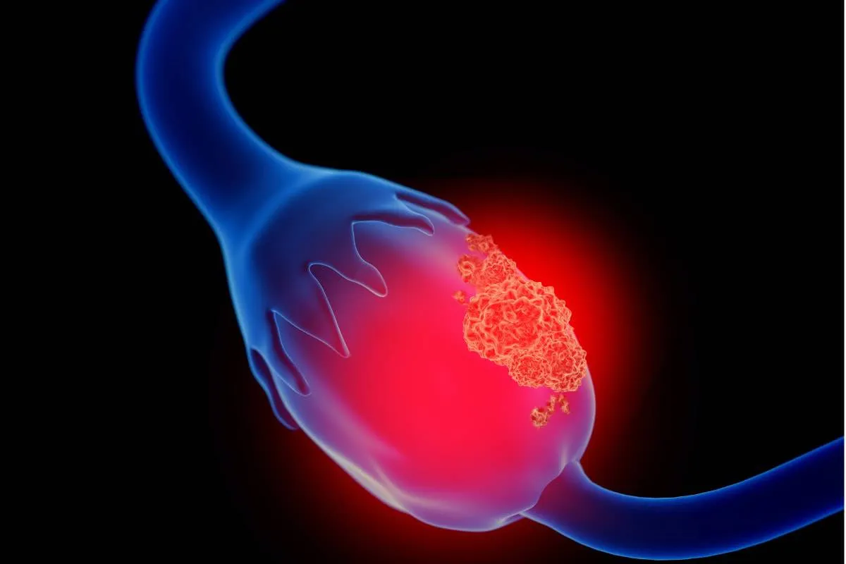 Ovarian Cancer