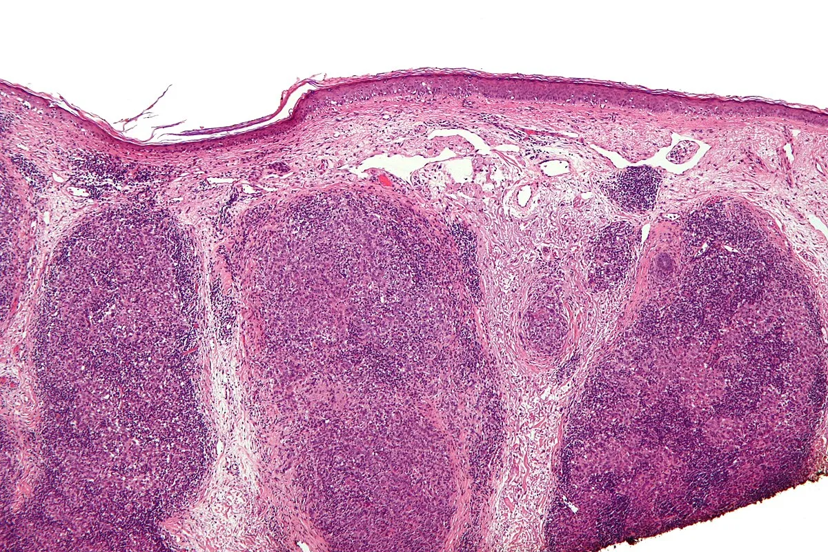 The Spectrum of Epithelial Malignancies