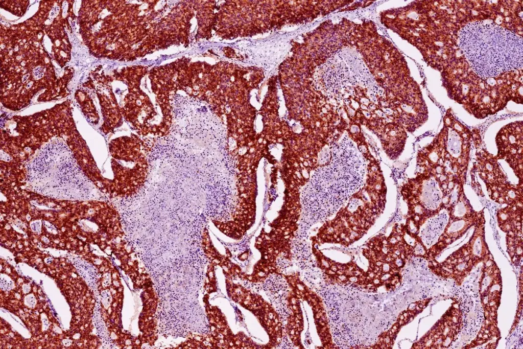 The Concept of Peritoneal Carcinomatosis