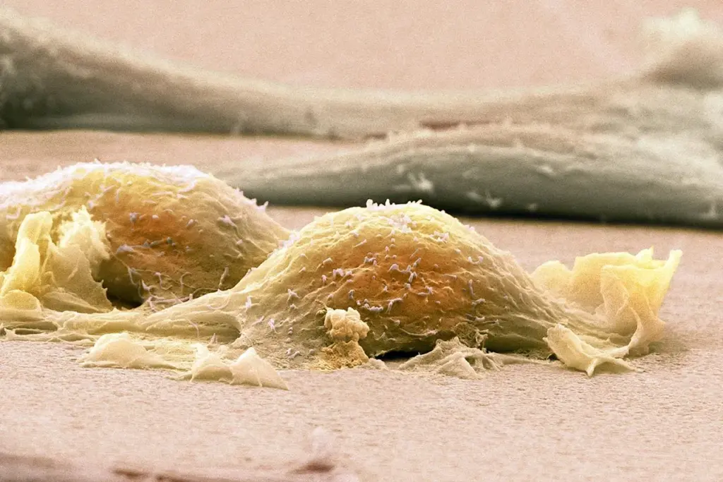 Pathological Classification and Biomarkers