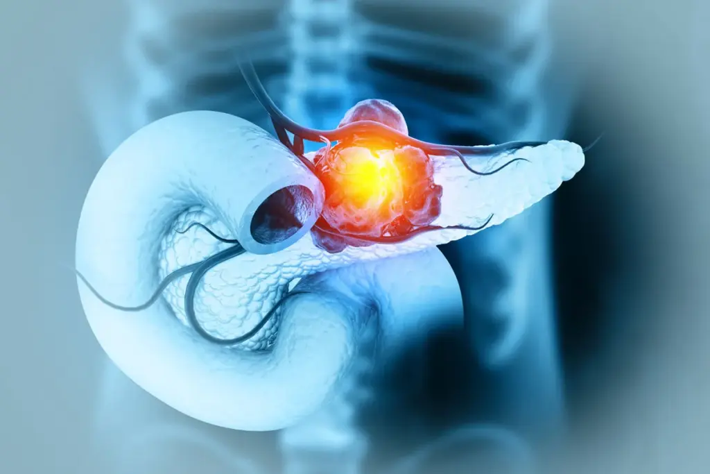 Classification of Pancreatic Neoplasms