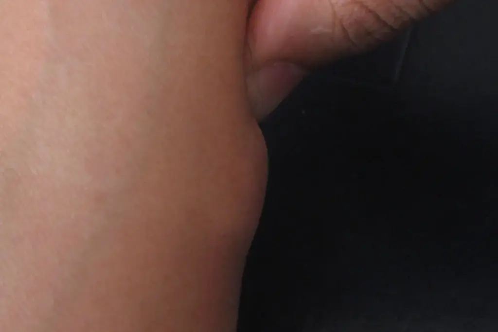 Hereditary Syndromes Associated with Sarcoma