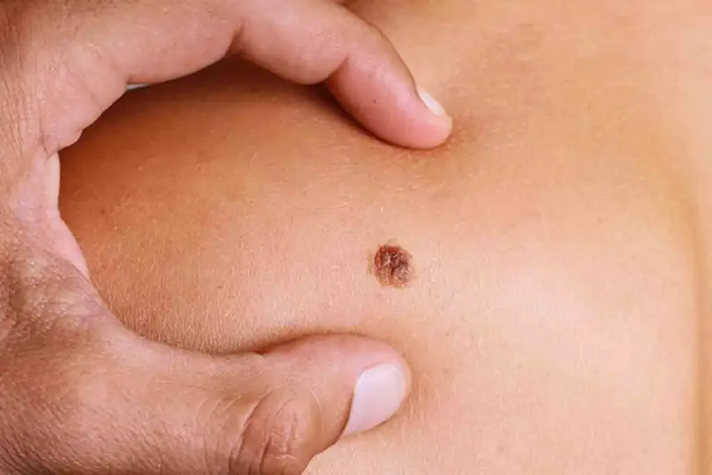 Surgical Management: Wide Local Excision