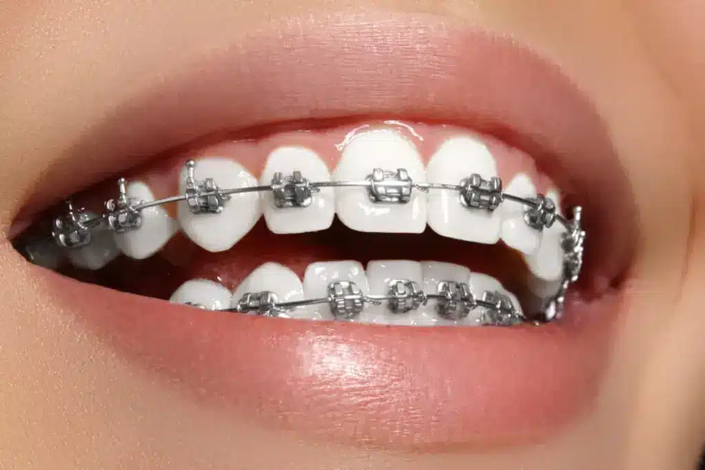 Metal Braces: Overview and Definition
