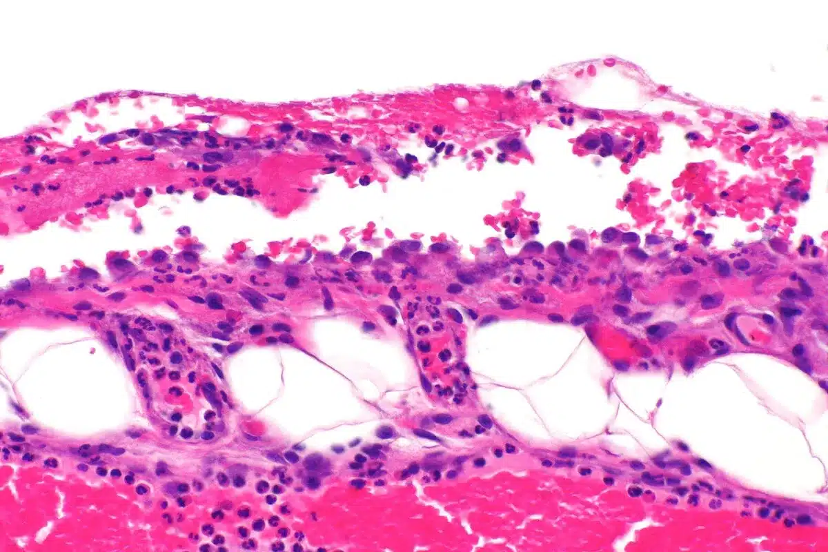 Understanding Pericardial Chest Pain