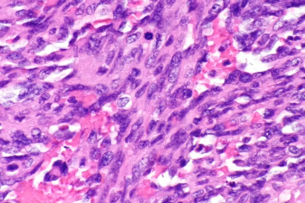 What is a renal angiogram?