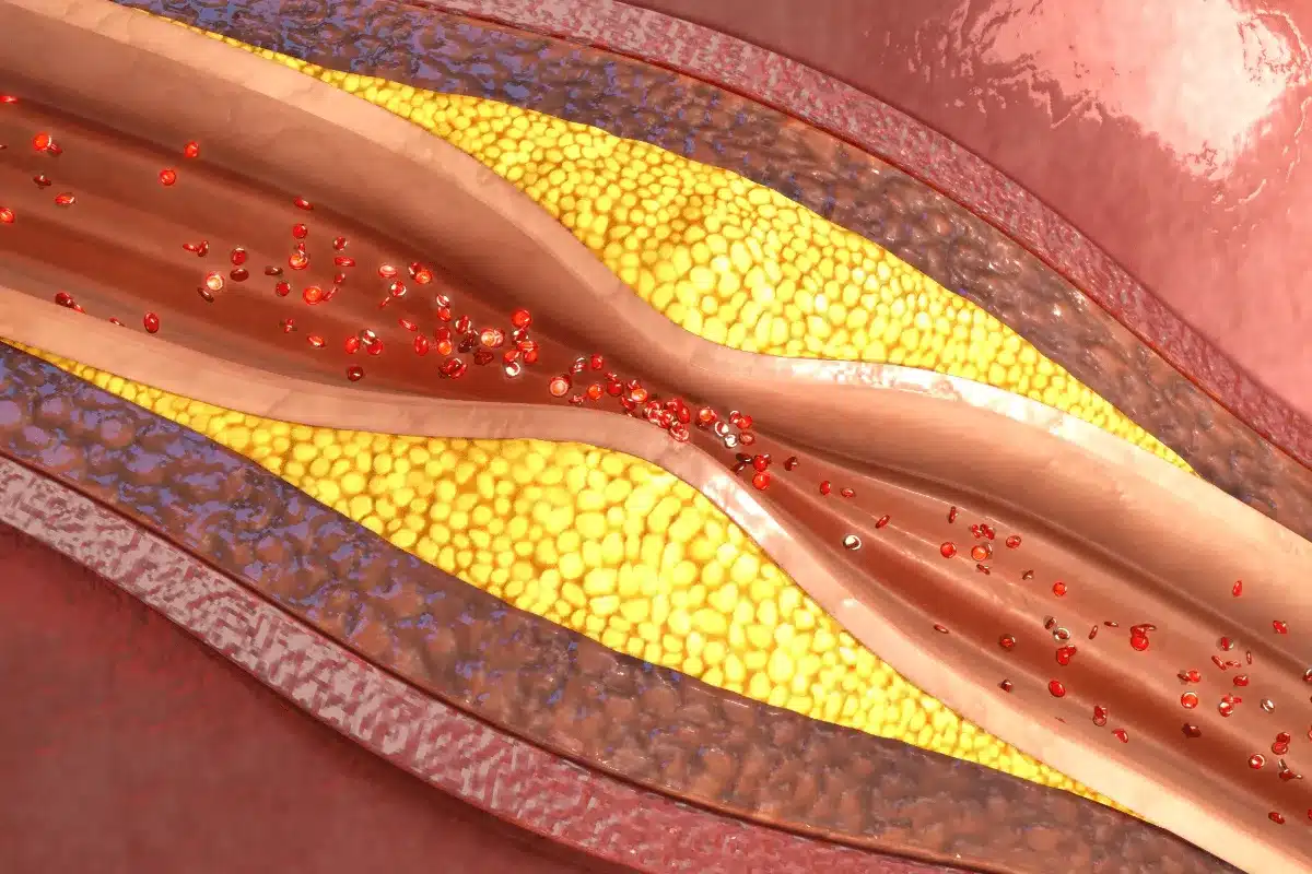 Understanding Atherosclerosis