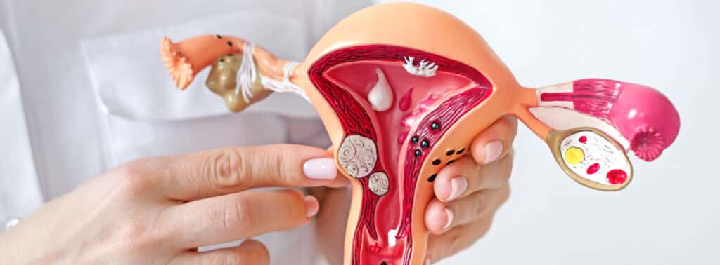 gynecologist points his finger fibroid tumors model female uterus with pathologies 1 1 LIV Hospital