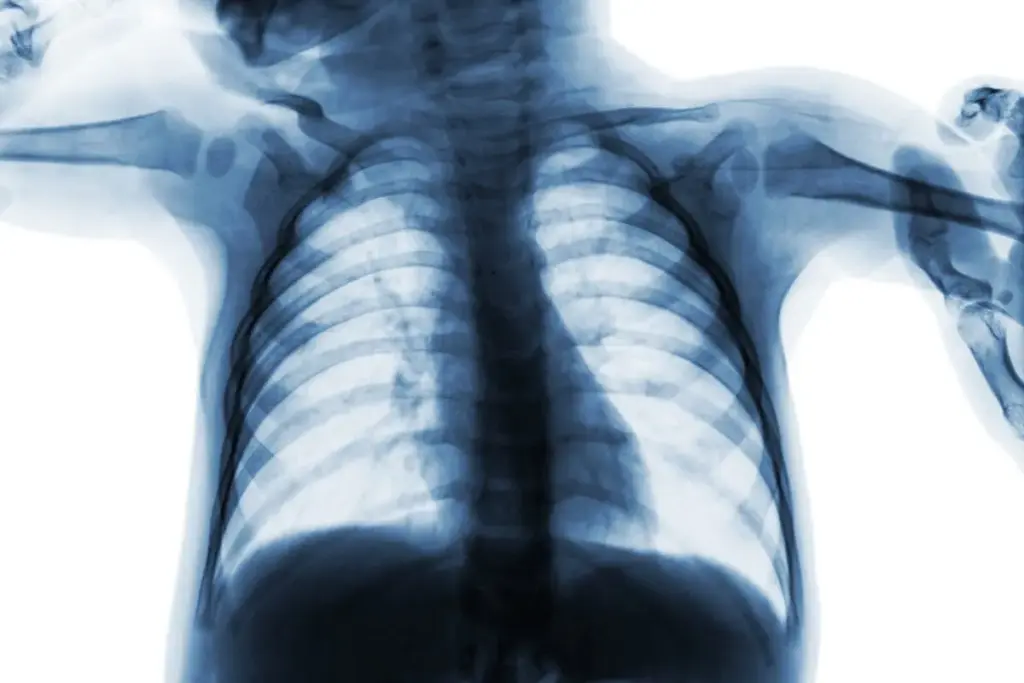 Chest Radiography Indications