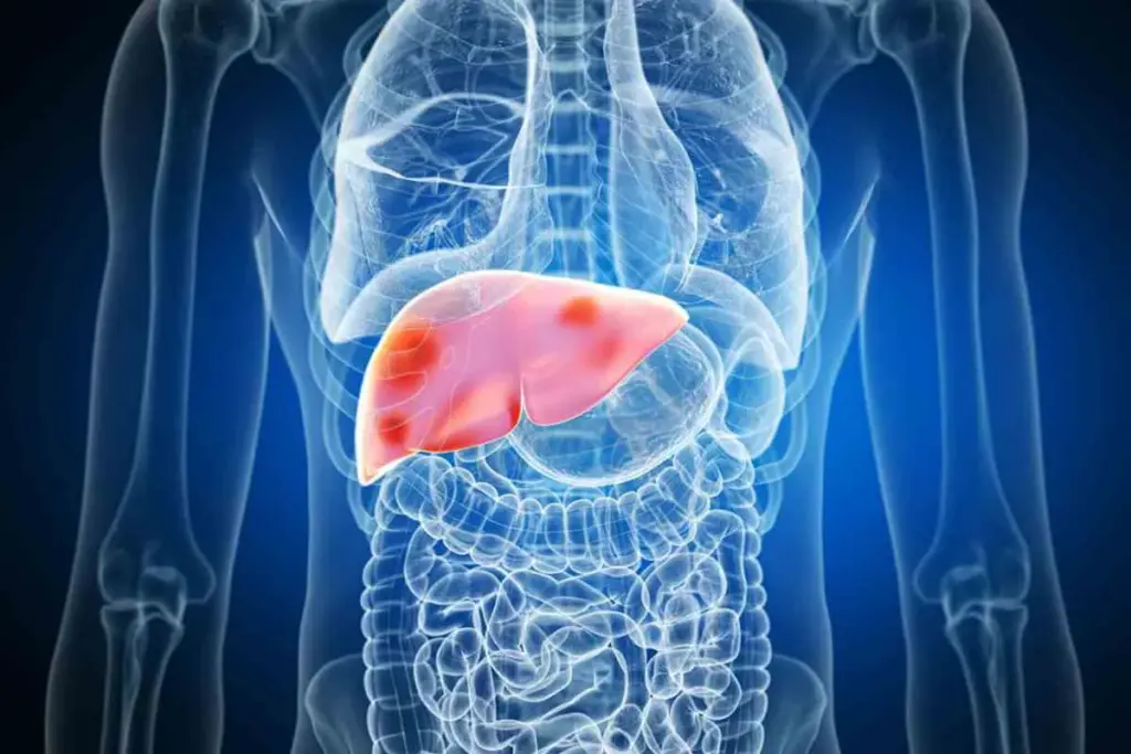 Hemochromatosis: Overview and Definition