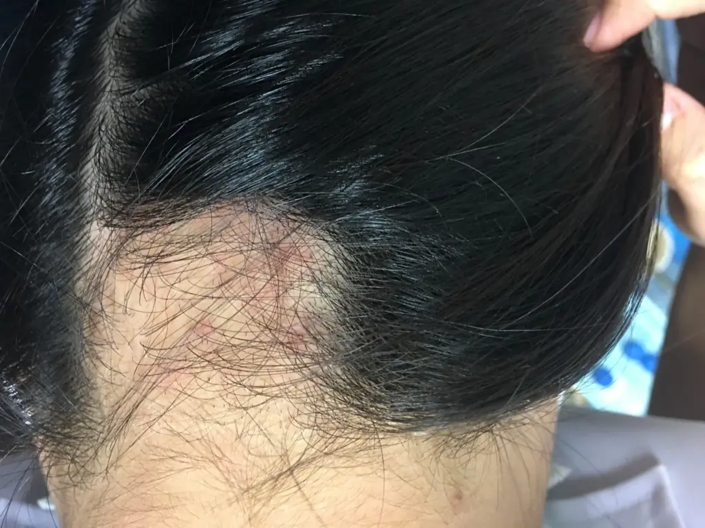 trichotillomania-hair-pulling