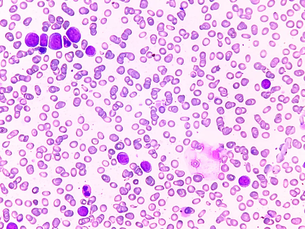 acute-lymphocytic-leukemia
