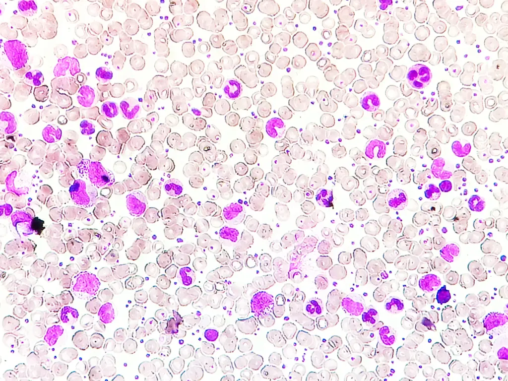 acute-lymphocytic-leukemia
