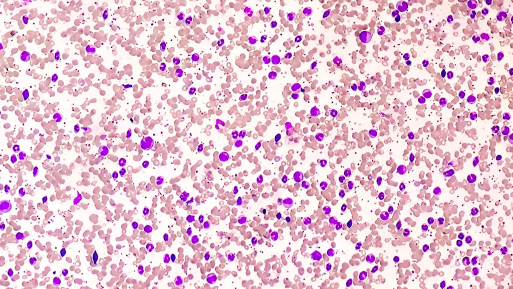 acute-myelogenous-leukemia