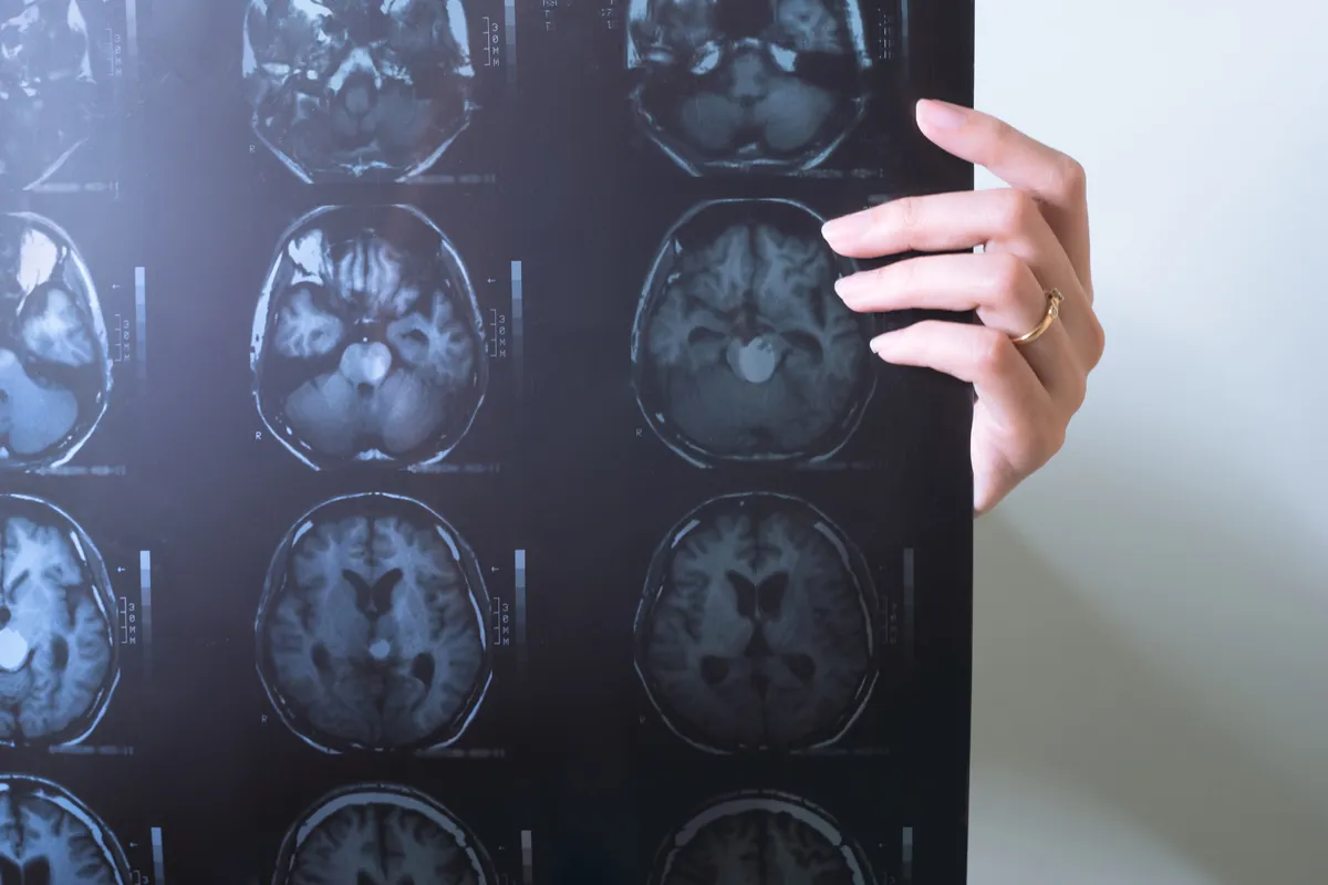 Cerebrovascular Disease: Overview and Definition