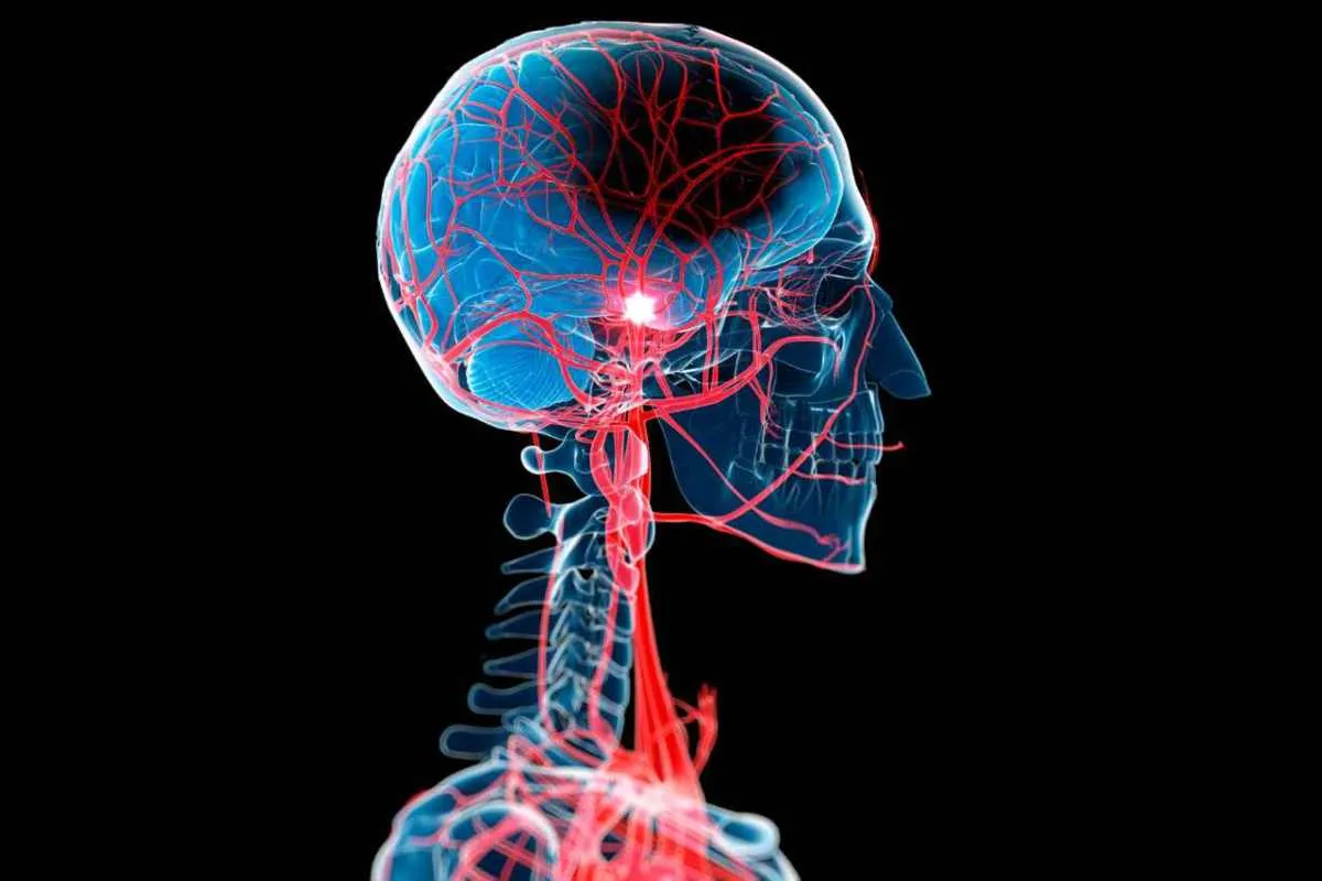 Cerebral Venous Disease