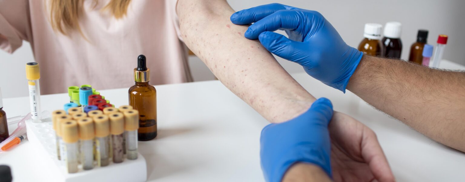 skin allergy person s arm 1 LIV Hospital